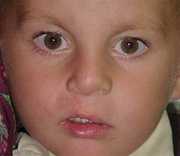 Cleft Lip and Palate